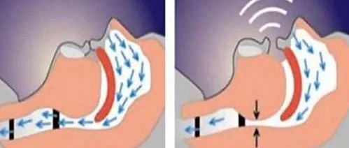 打鼾那么多年真没事吗?