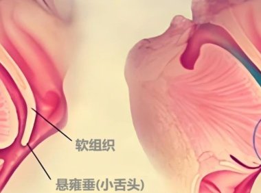 打呼噜是什么原因引起的？一次说清楚！